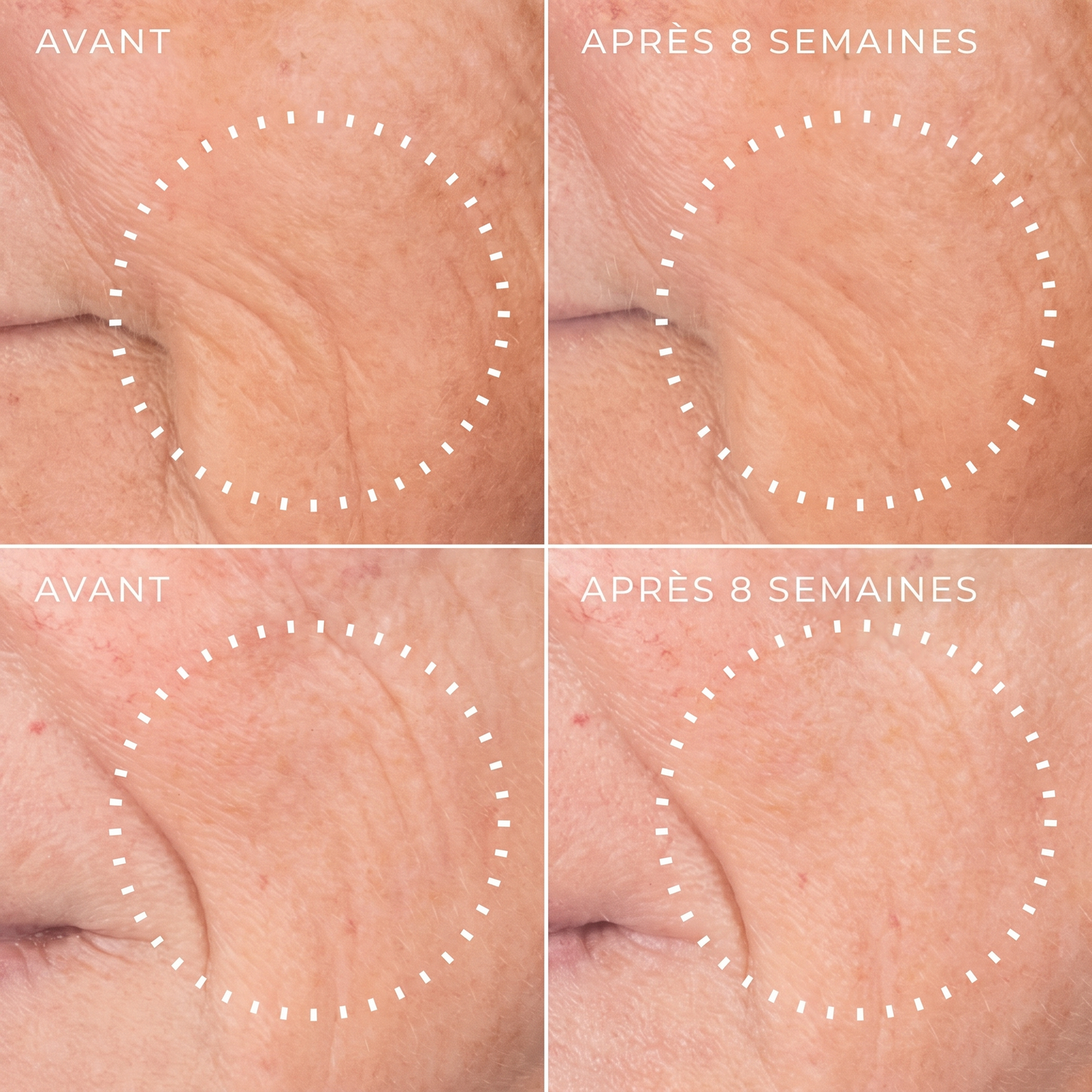 Grain de peau affiné au bout de huit semaines